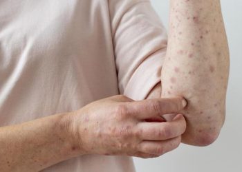 Infeksi Primer Varicella Zoster Virus VZV pada Anak yang Perlu Dikenali